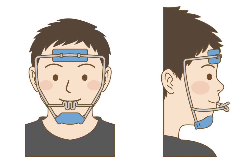 上顎前方牽引装置